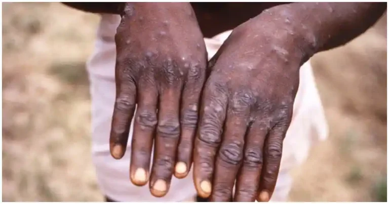 Health Experts identify strange skin disease in Jirapa-Tizza as Scabies